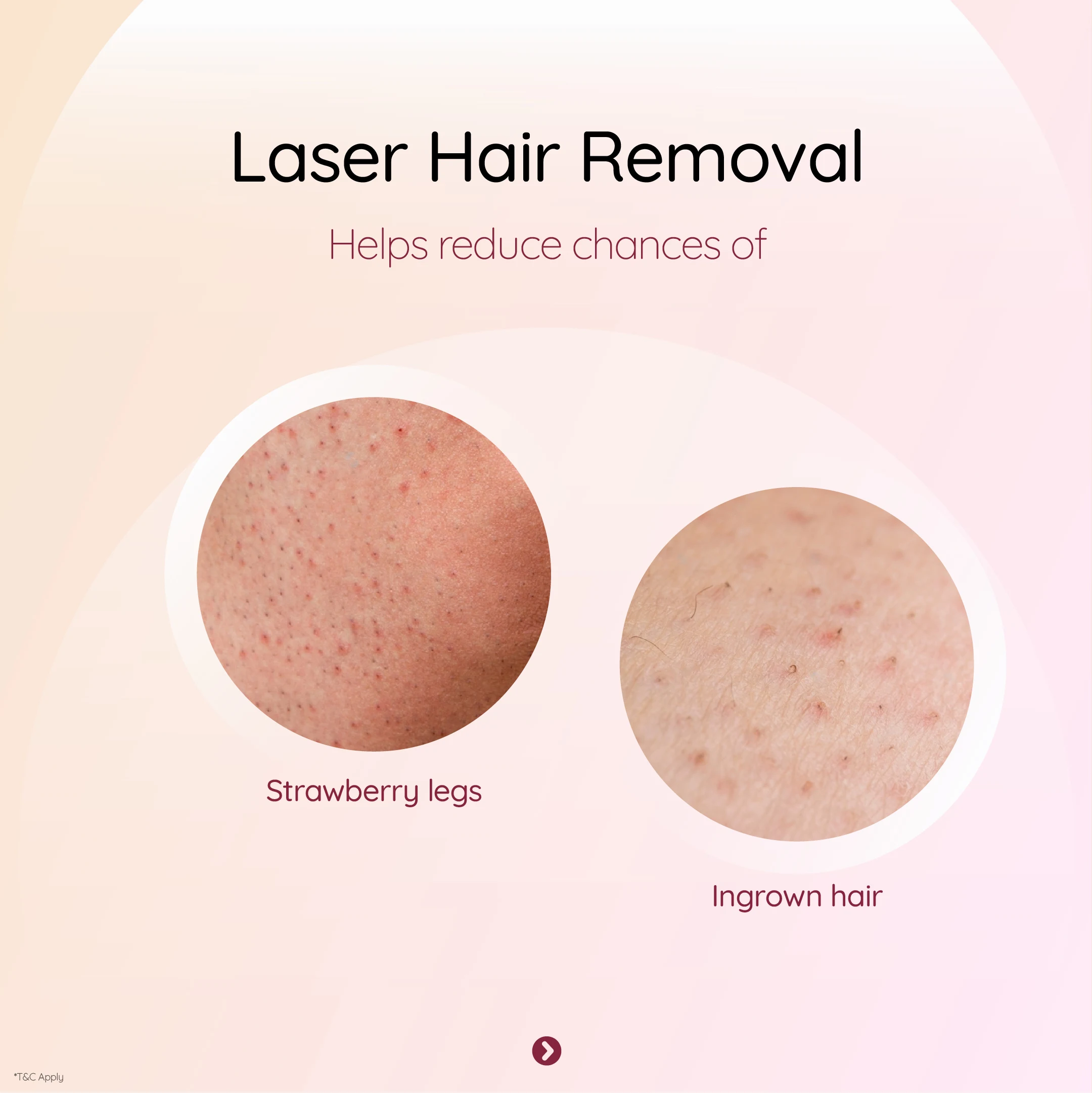 Laser Hair Removal